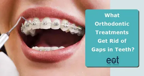 What to Call Someone with a Gap in Their Teeth